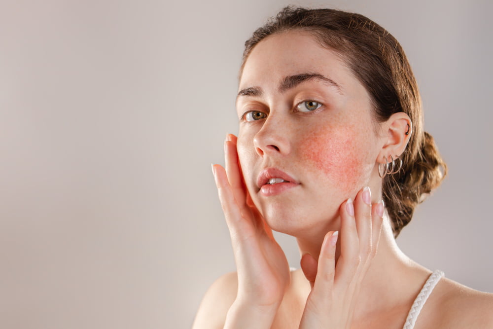 Red Light Therapy for Rosacea