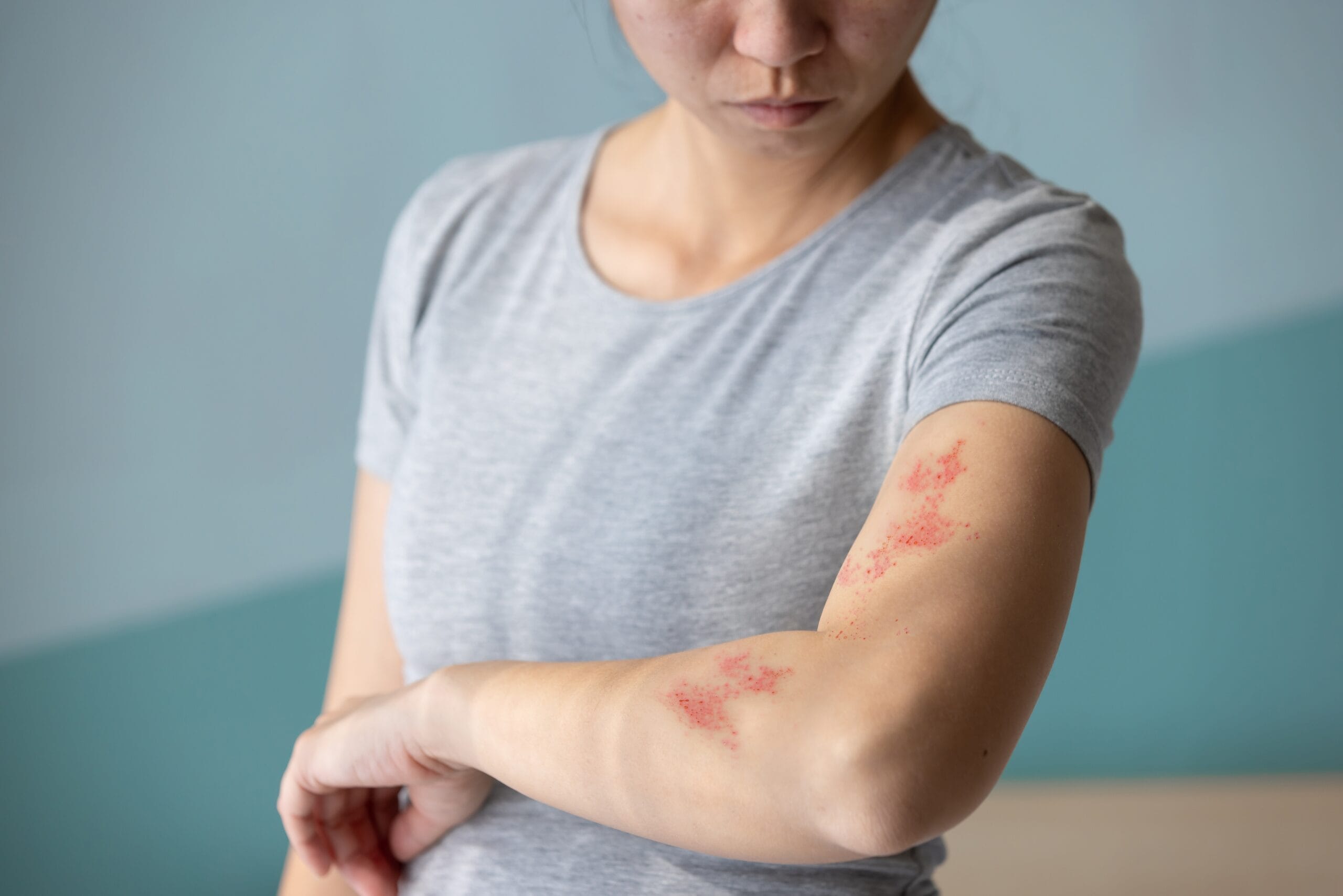 Red Light Therapy for Shingles